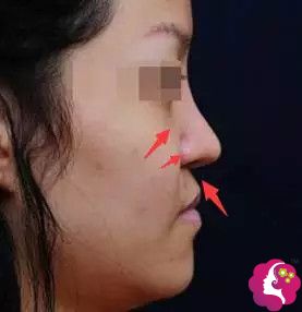 鼻基底凹陷会产生月亮脸既视感 鼻基底凹陷会产生月亮脸既视感