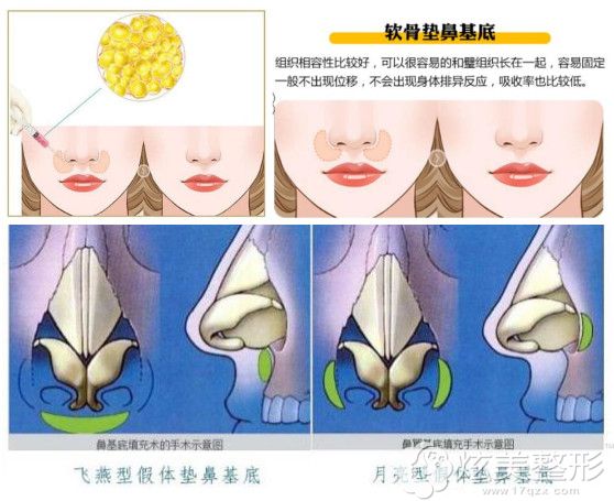 济南艺星医生分析鼻基底凹的填充改善方案 济南艺星医生分析鼻基底凹的填充改善方案