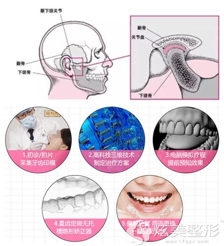 康贝佳口腔门诊部矫正深覆合过程 康贝佳口腔门诊部矫正深覆合过程