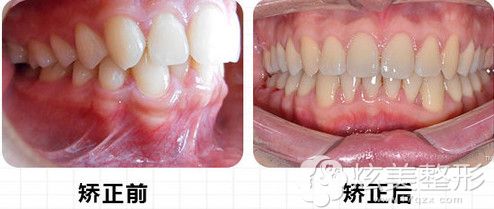 北京康贝佳口腔门诊部矫正三度深覆合矫正案例 北京康贝佳口腔门诊部矫正三度深覆合矫正案例