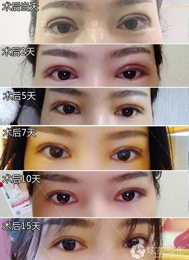 宝鸡高一生双眼皮案例 宝鸡高一生双眼皮案例