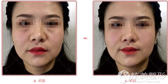 宝鸡高一生去眼袋案例 宝鸡高一生去眼袋案例