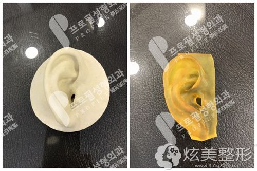 耳再造可改善耳部畸形问题 耳再造可改善耳部畸形问题