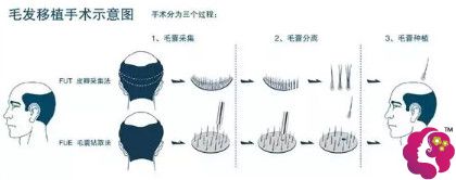 尚俊医生做FUE植发手术过程 尚俊医生做FUE植发手术过程