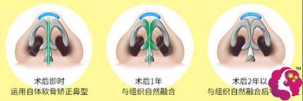 曾德浩做鼻综合手术过程 曾德浩做鼻综合手术过程