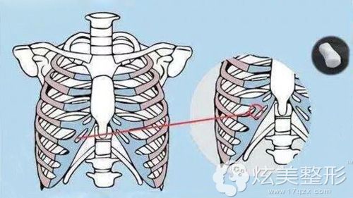 在胸部要取肋骨的部位 在胸部要取肋骨的部位