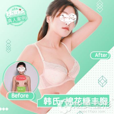济南韩氏棉花糖丰胸案例 济南韩氏棉花糖丰胸案例