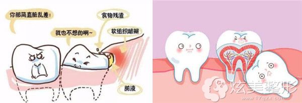 牙齿矫正中需要拔除智齿的几种情况 牙齿矫正中需要拔除智齿的几种情况