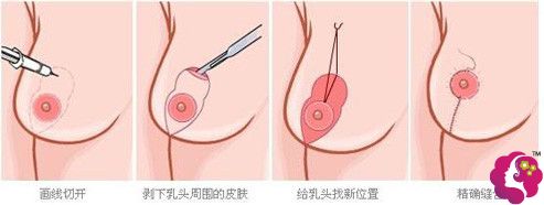 乳房上提术手术步骤示意图 乳房上提术手术步骤示意图