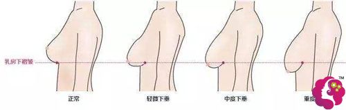 四种不同程度的胸部下垂程度 四种不同程度的胸部下垂程度
