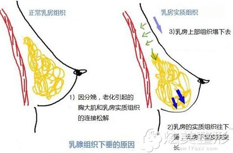 哺乳前和哺乳后的胸部变化示意图 哺乳前和哺乳后的胸部变化示意图