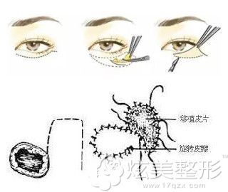眼皮外翻采用皮瓣移植眼睑成形术修复 眼皮外翻采用皮瓣移植眼睑成形术修复