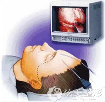 内窥镜除皱的手术原理示意图 内窥镜除皱的手术原理示意图