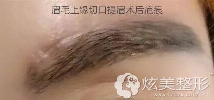 提眉术后可能会留一条线的疤痕 提眉术后可能会留一条线的疤痕