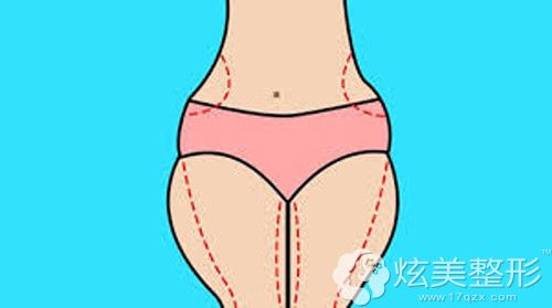 大腿吸脂术前划线 大腿吸脂术前划线