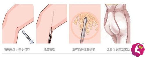 大腿吸脂术后2个月粗细不同做修复手术 大腿吸脂术后2个月粗细不同做修复手术