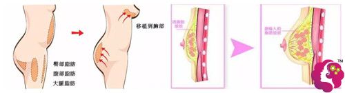 轻度胸部下垂可以选择脂肪丰胸术 轻度胸部下垂可以选择脂肪丰胸术