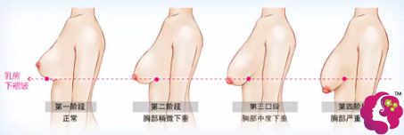 产后胸部下垂厉害可以选择脂肪丰胸和乳房上提手术 产后胸部下垂厉害可以选择脂肪丰胸和乳房上提手术