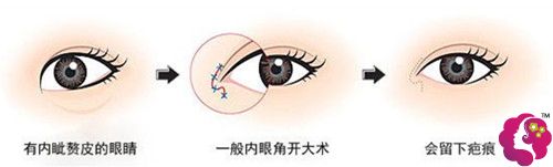 做开内眼角手术后可能留有疤痕 做开内眼角手术后可能留有疤痕