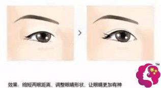 开完眼角前后对比 开完眼角前后对比