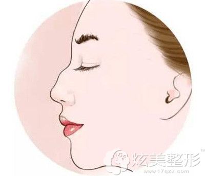 较重程度的驼峰鼻呈现效果 较重程度的驼峰鼻呈现效果