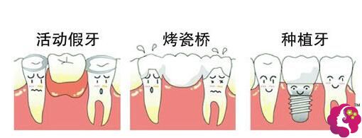 牙齿的修复方式:活动义齿→烤瓷牙→种植牙 牙齿的修复方式:活动义齿→烤瓷牙→种植牙