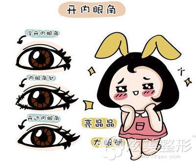 开内眼角手术步骤示意图 开内眼角手术步骤示意图