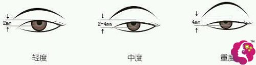 不同程度的内眦赘皮呈现的效果 不同程度的内眦赘皮呈现的效果