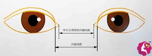 正常情况下做完开内眼角后的眼距 正常情况下做完开内眼角后的眼距