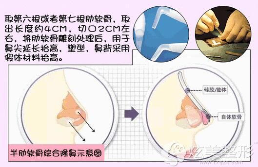 半肋隆鼻手术原理图 半肋隆鼻手术原理图