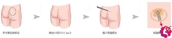 吸脂瘦臀部手术原理 吸脂瘦臀部手术原理