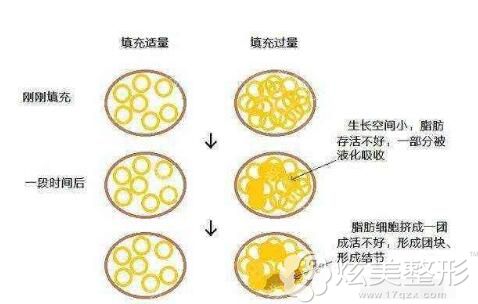 硬块结节的脂肪不会癌变 硬块结节的脂肪不会癌变