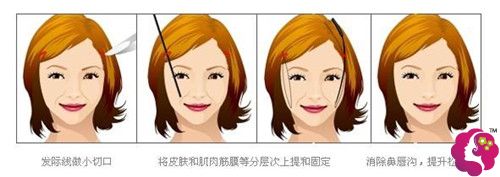 筋膜悬吊除皱术修复后的效果显著 筋膜悬吊除皱术修复后的效果显著