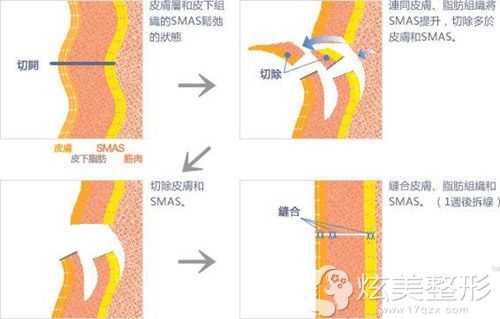 筋膜悬吊术除皱原理 筋膜悬吊术除皱原理