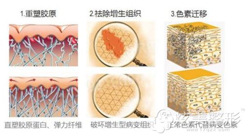 co2点阵激光修复凹陷疤痕效果 co2点阵激光修复凹陷疤痕效果