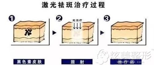 超皮秒祛斑的手术示意图 超皮秒祛斑的手术示意图