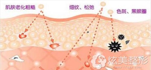 光子嫩肤祛斑的手术原理 光子嫩肤祛斑的手术原理