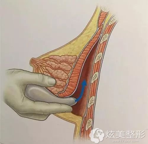 假体植入胸部的过程 假体植入胸部的过程