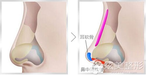鼻综合修复手术的原理图 鼻综合修复手术的原理图