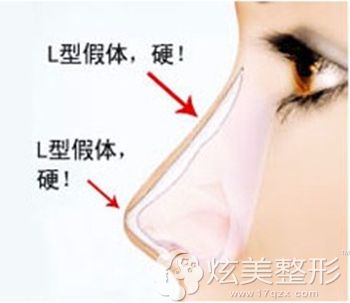 鼻头出现上旋是因为使用了L型假体 鼻头出现上旋是因为使用了L型假体
