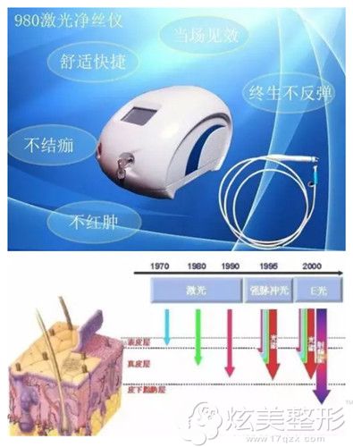 980激光去红血丝原理 980激光去红血丝原理
