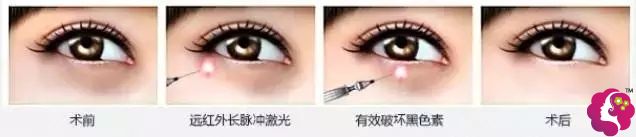 激光改善黑眼圈更适合色素型黑眼圈 激光改善黑眼圈更适合色素型黑眼圈