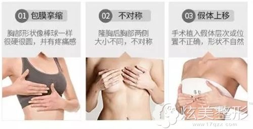 隆胸术后可能会出现的后遗症 隆胸术后可能会出现的后遗症
