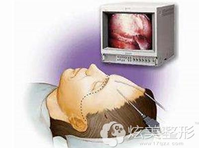 筋膜悬吊除皱术的手术步骤示意图 筋膜悬吊除皱术的手术步骤示意图