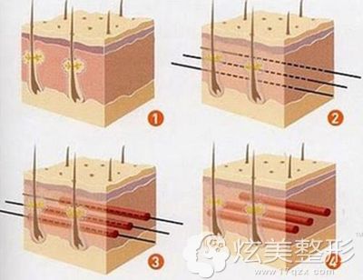 埋线提升的手术原理图 埋线提升的手术原理图