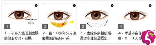 热效溶脂去眼袋的治疗原理图 热效溶脂去眼袋的治疗原理图