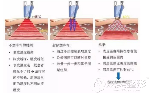 射频溶脂去眼袋的治疗原理图 射频溶脂去眼袋的治疗原理图