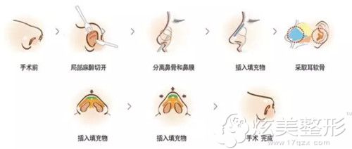 耳软骨隆鼻手术过程 耳软骨隆鼻手术过程