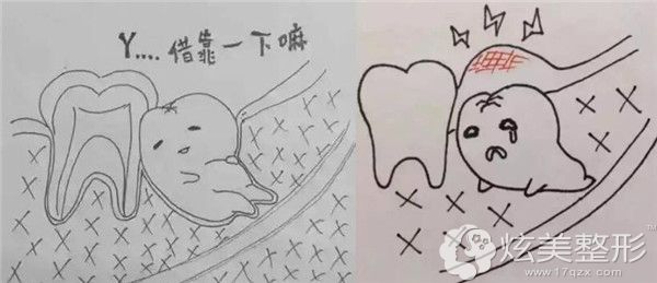 埋伏牙可能引发多种口腔问题 埋伏牙可能引发多种口腔问题