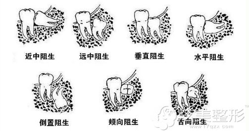 阻生齿的几种情况 阻生齿的几种情况